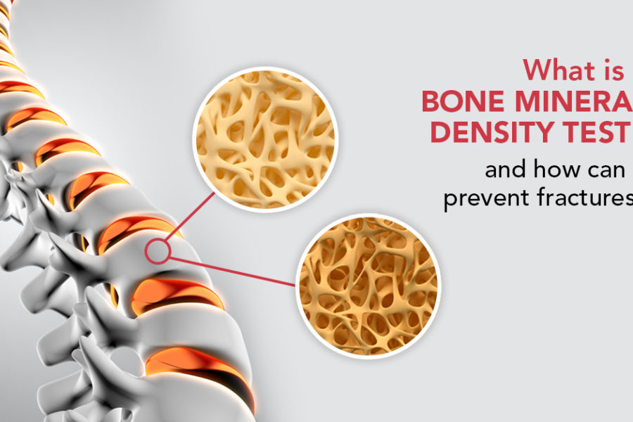 Bone Mineral Density Test