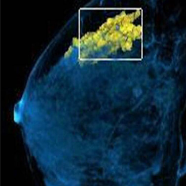 Star3t breast_Imaging